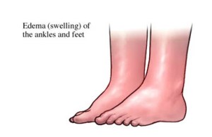 Book-Edema